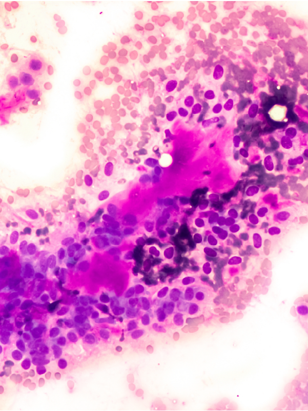 Salivary Gland Neoplasms