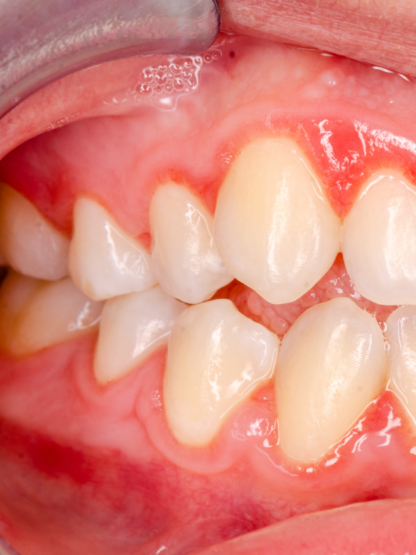 Desquamative Gingivitis