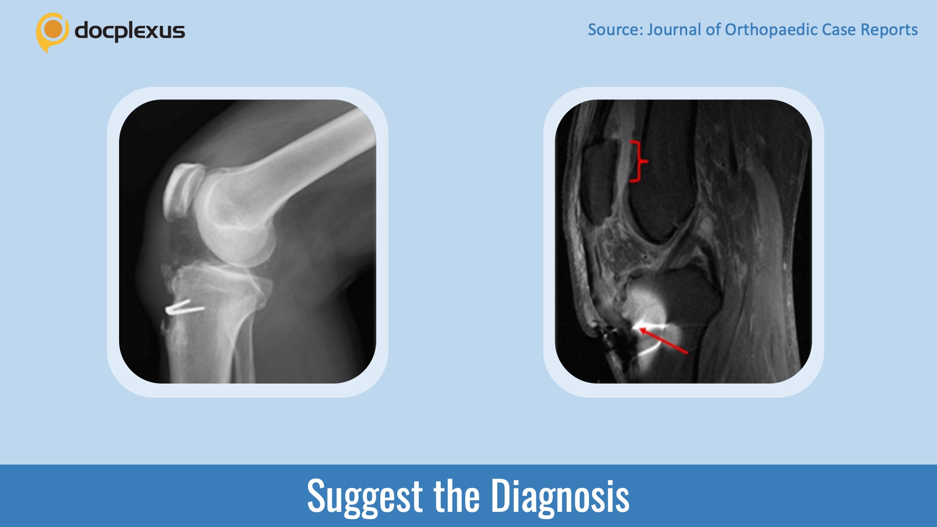 An Exacerbated Case of Osgood-Schlatter Disease