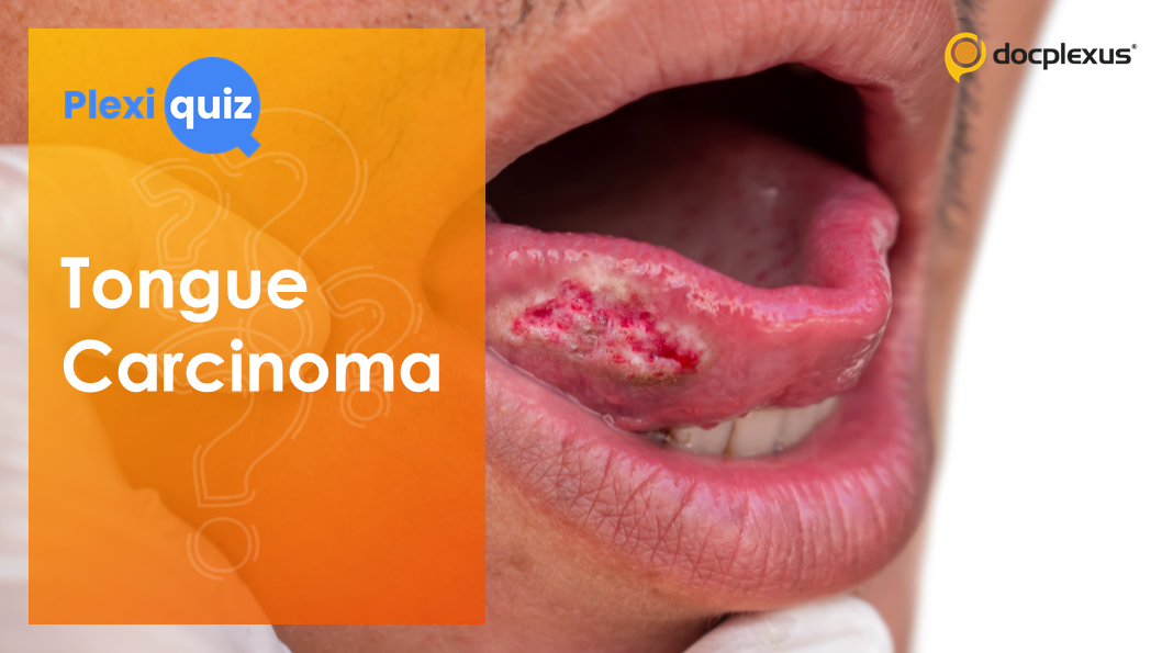 Quiz on Tongue Carcinoma