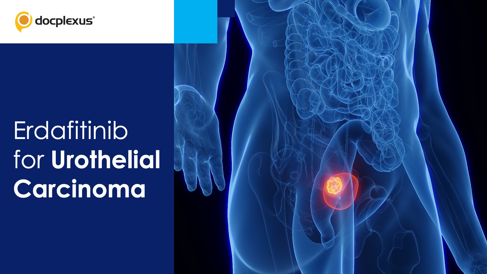 USFDA Approves Erdafitinib for Treating Urothelial Carcinoma