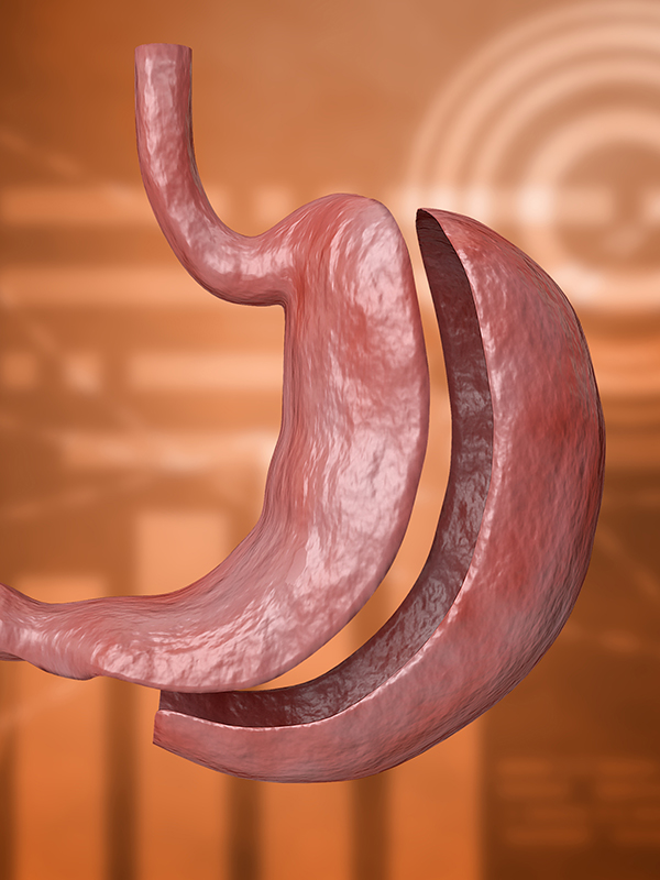 PCOS Pregnancy and Bariatric Surgery