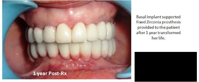 Full Mouth Rehabilitation with Immediate Loading Dental Implants