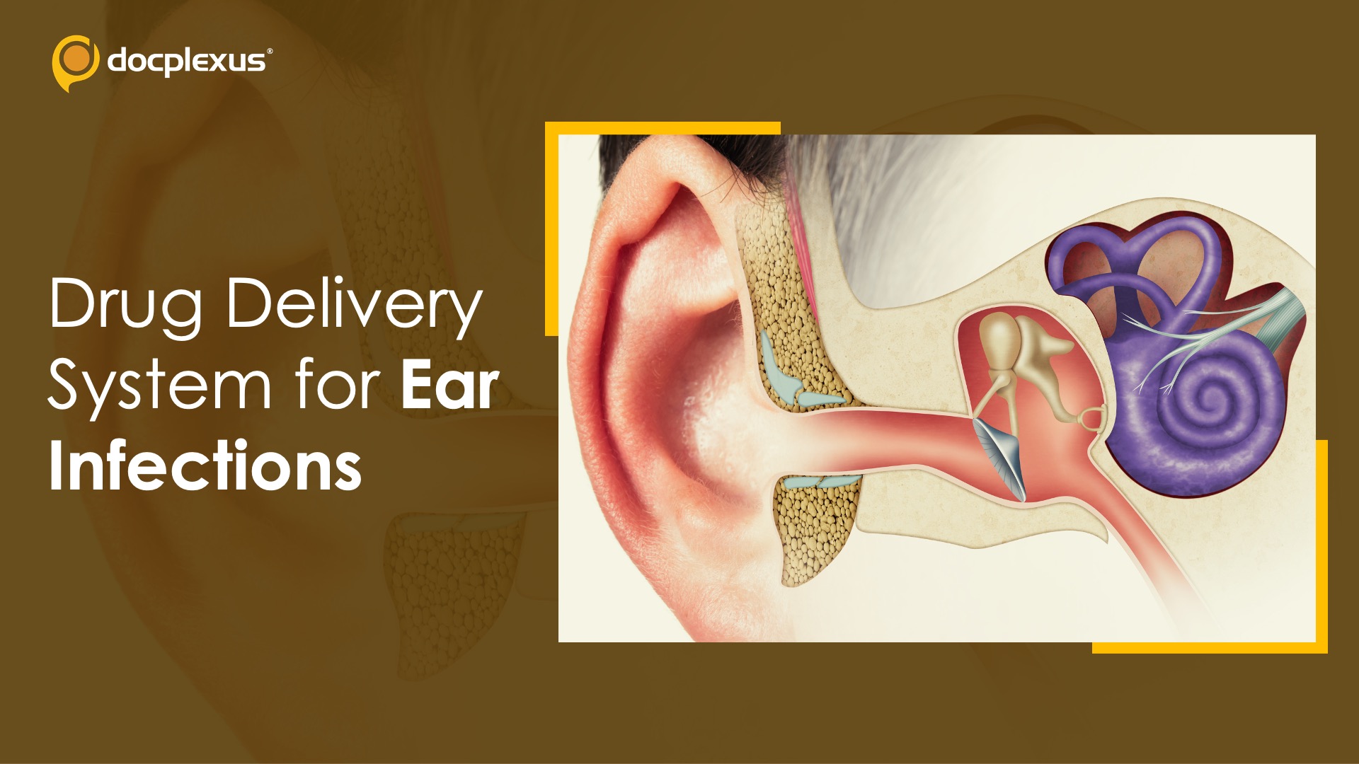 Modified Drug Delivery System for Recurrent Ear Infections