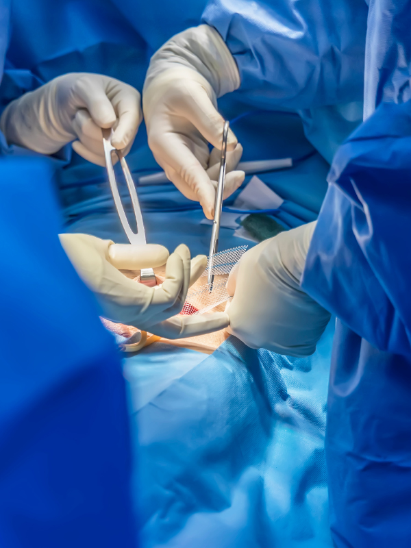 Peritoneal Flap Technique for Large Complex Ventral Hernias