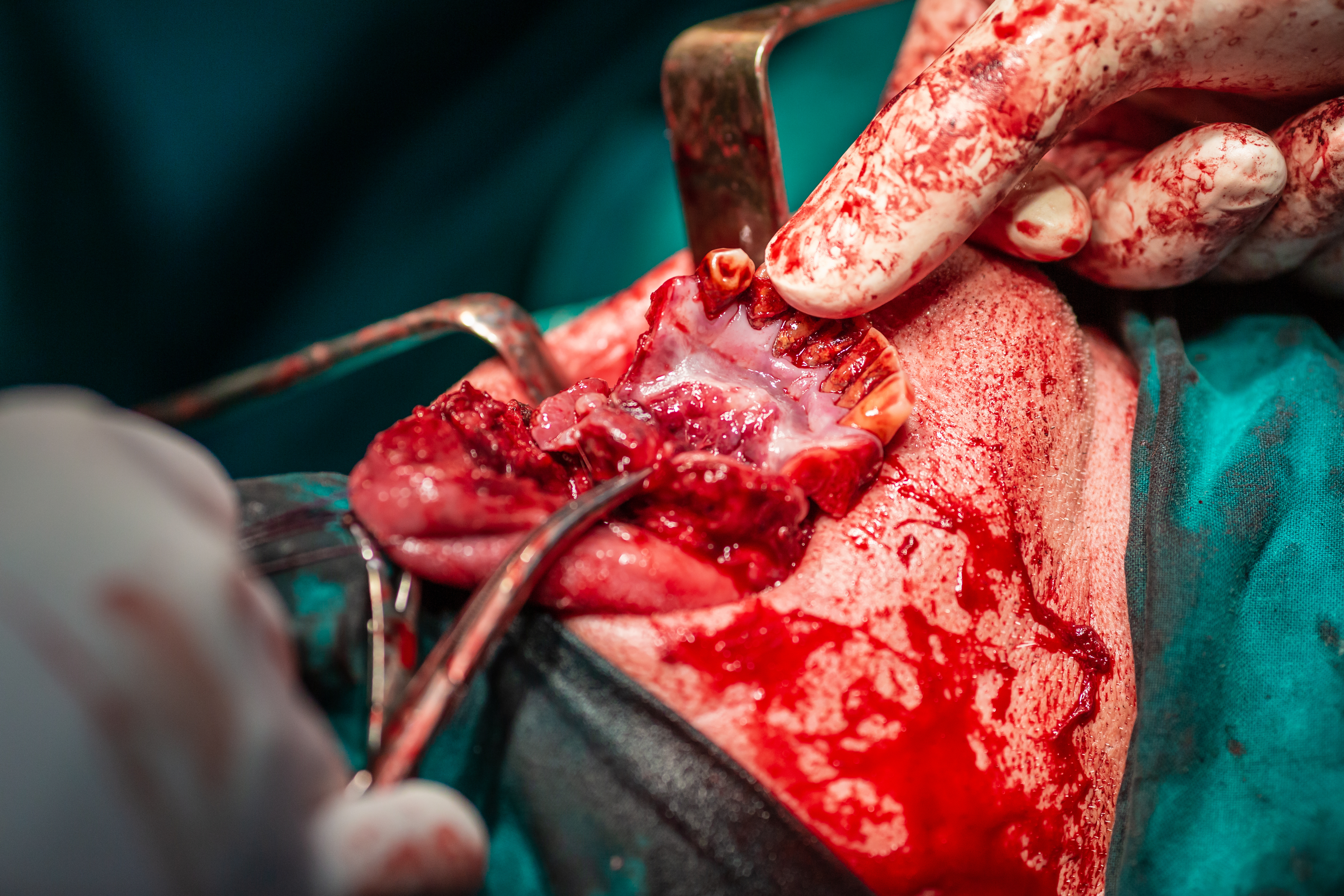 Surgical Fibrolysis and Skin Grafts in the Management of Oral Submucous Fibrosis