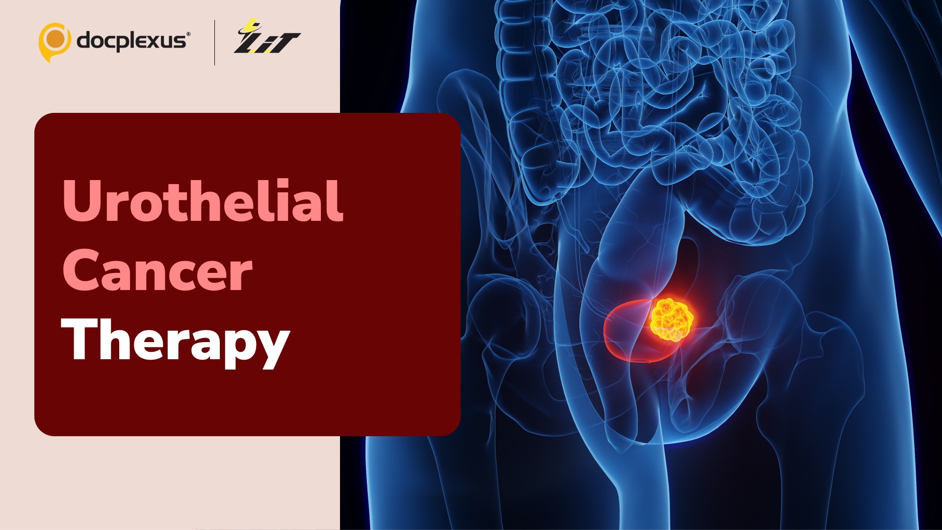 A Breakthrough Therapy for Urothelial Cancer