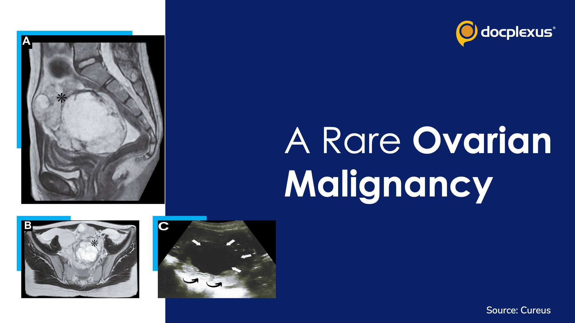 A Rare Ovarian Malignancy in a Young Girl