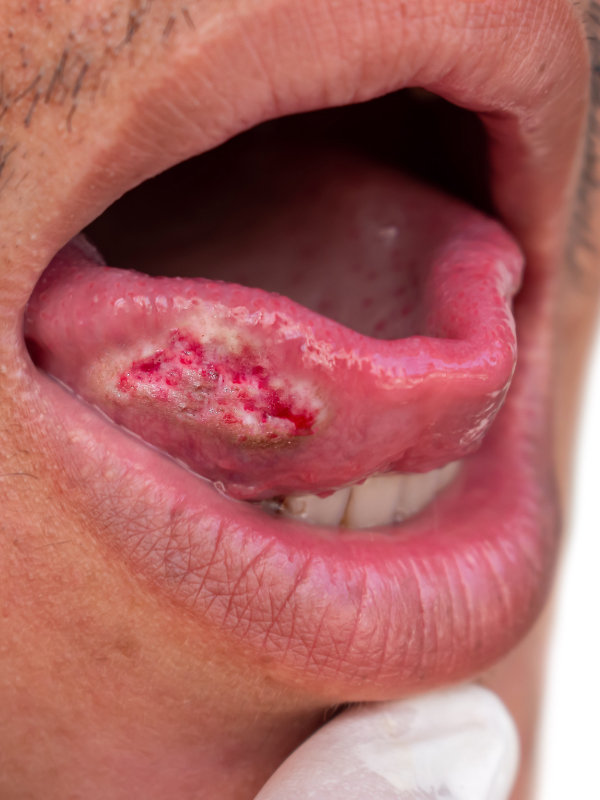 Management of Carcinoma Tongue