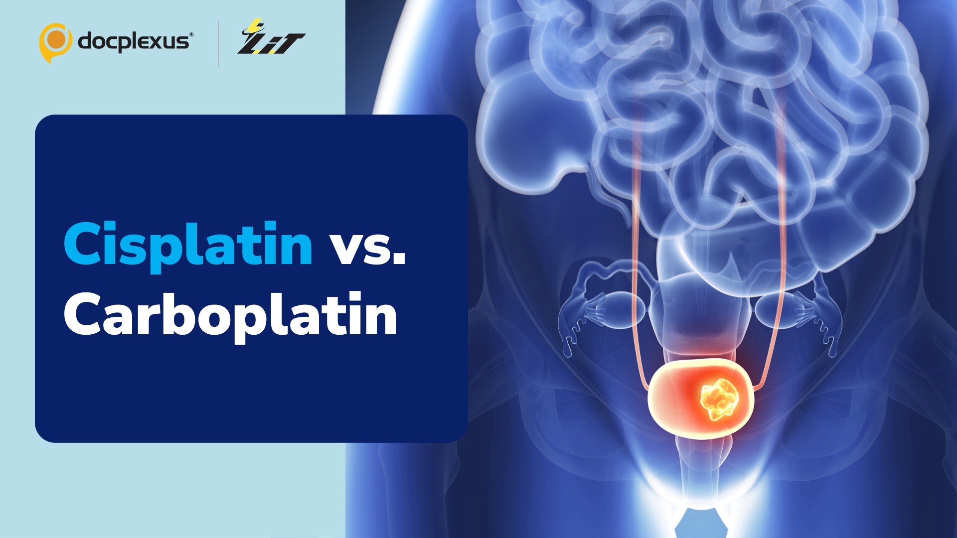Cisplatin vs. Carboplatin: Improved Outcomes in Urothelial Cancer Treatment