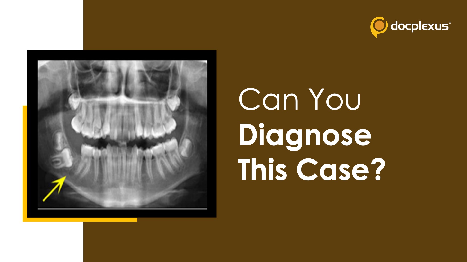 A Non-expansile Radiolucent Lesion: An Incidental Finding