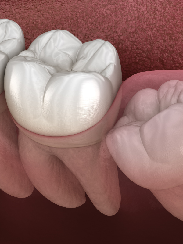 Third Molar Impaction