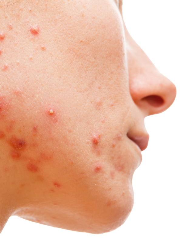 Acne Treatment Update