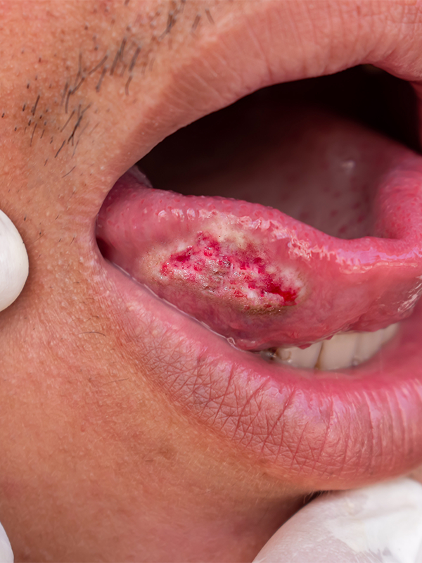 Compartment Resection of Advanced Buccal Cancer