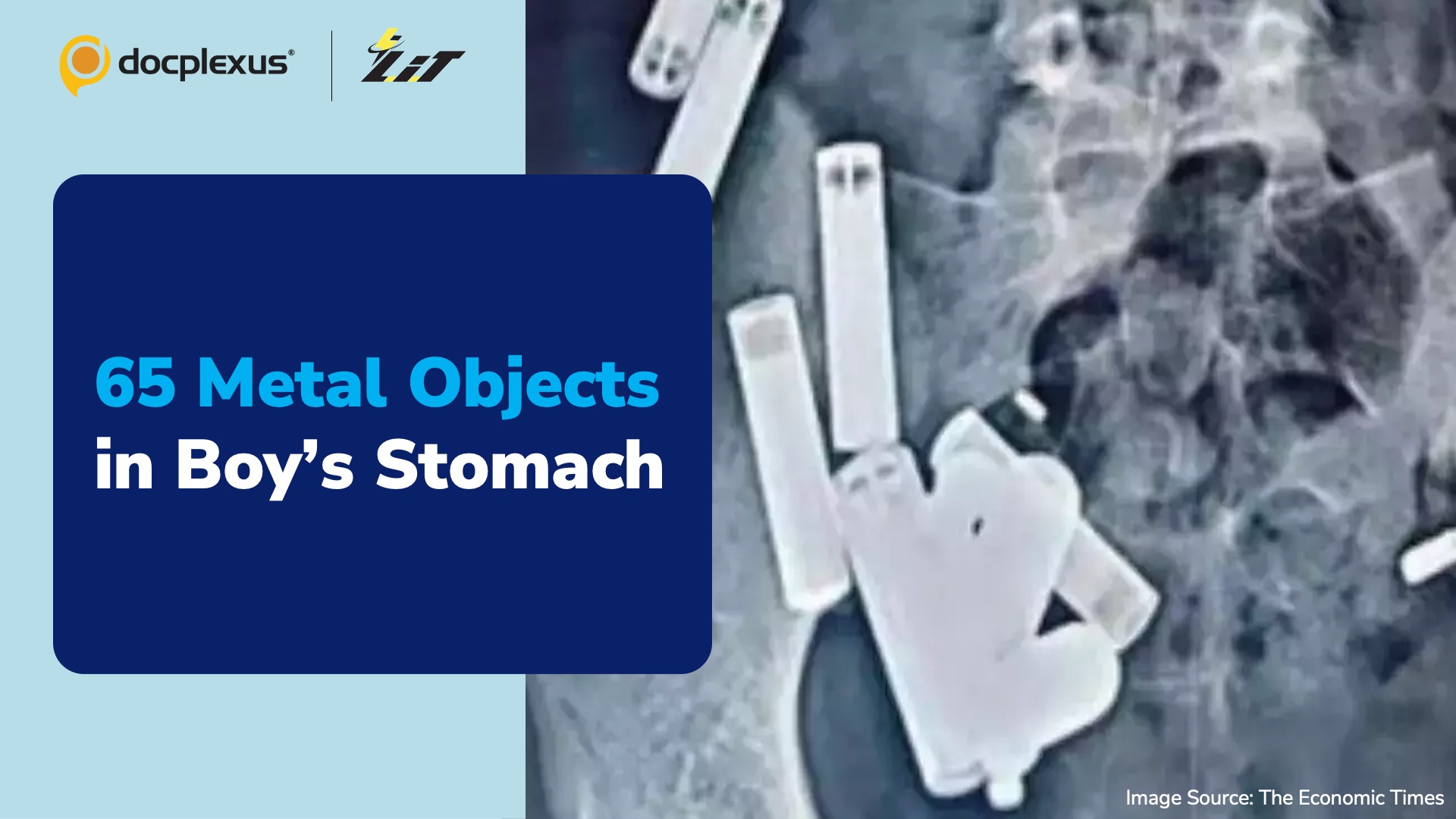 Doctors Remove 65 Metal Objects from Boy’s Stomach