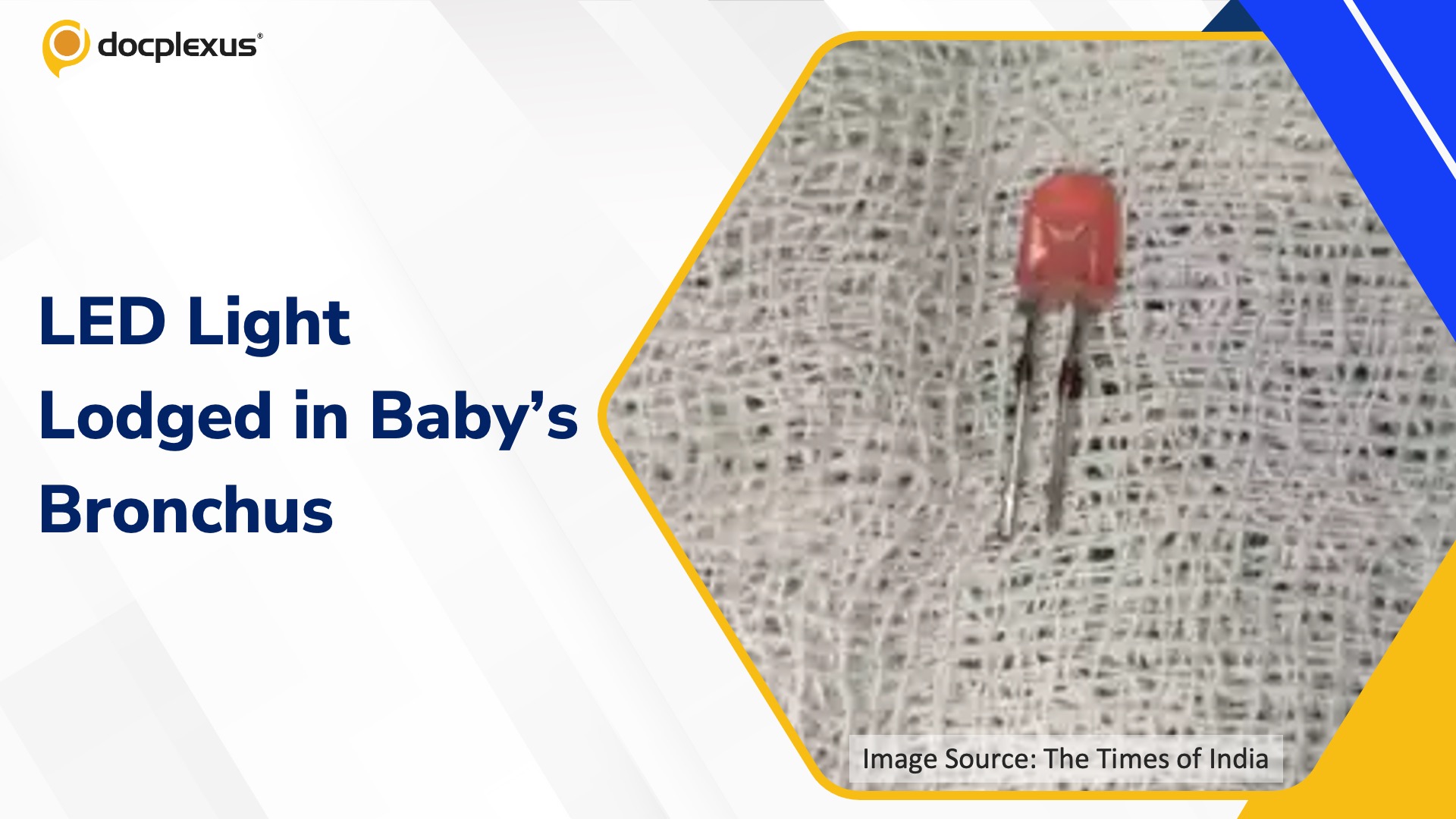 Doctors Remove LED Light from Infant’s Lung