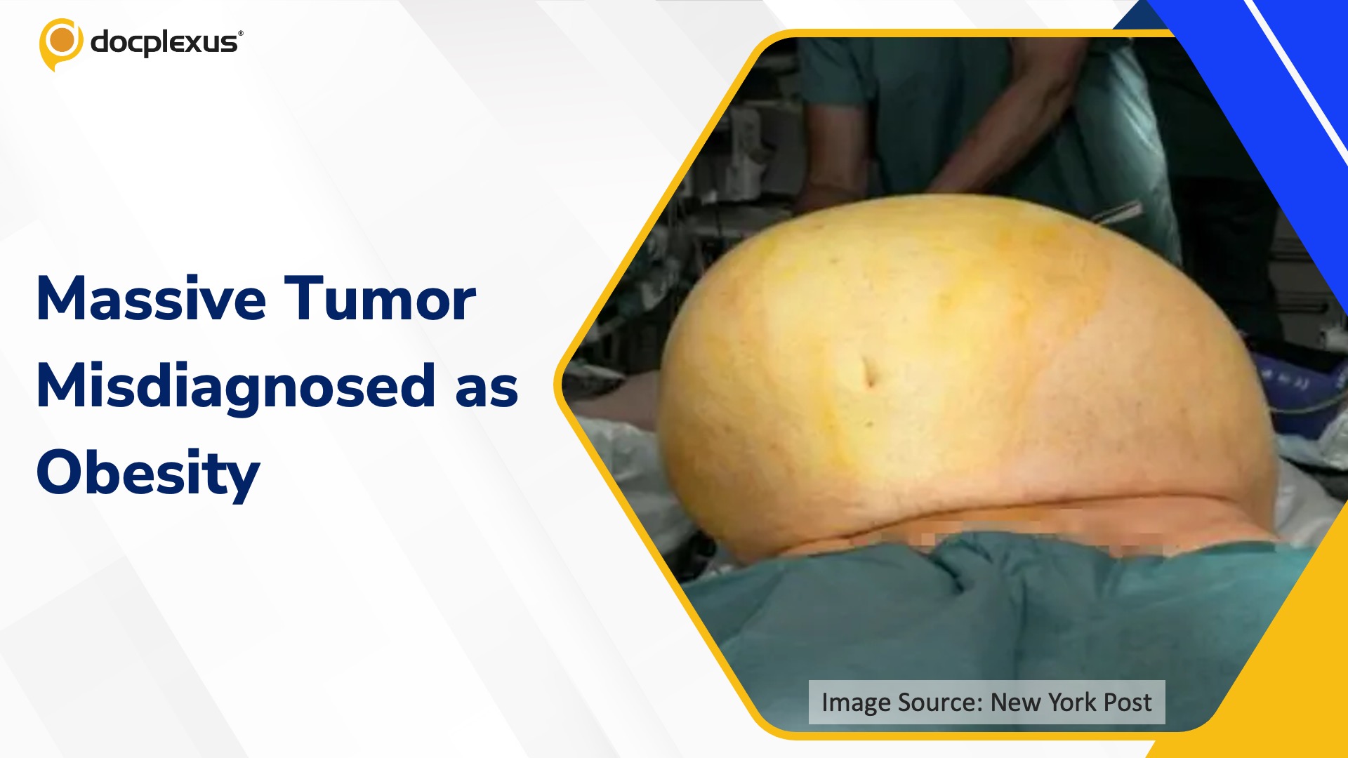 Doctors Misdiagnose Massive Tumor as Obesity for 12 Years