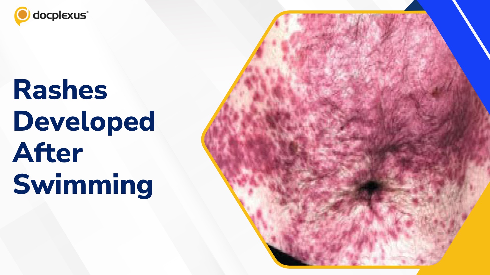 Diagnose These Rashes Developed After Swimming