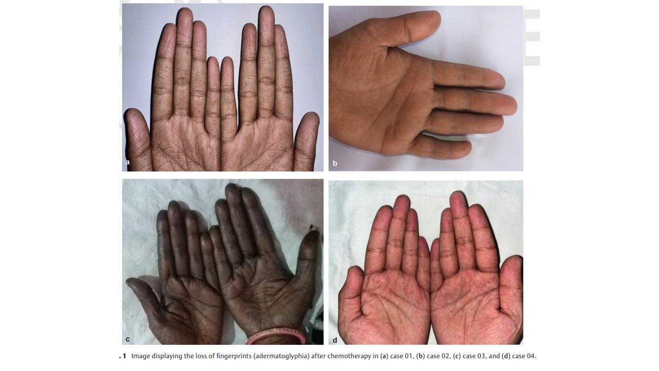 When Chemotherapy Erases Fingerprints: An Unexpected Barrier to Healthcare Access