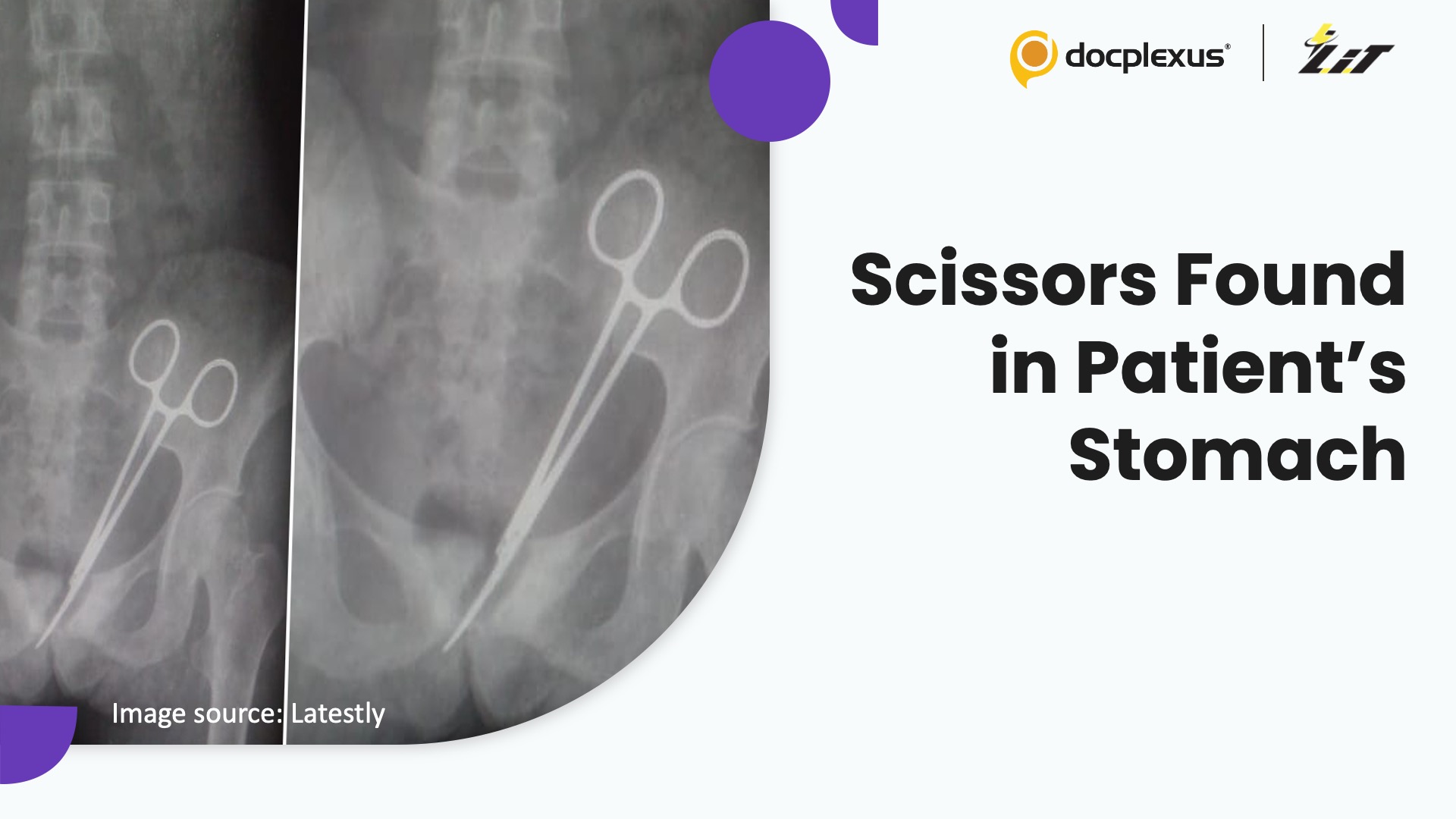 CT Scan Finds Scissors in Patient After Two Years