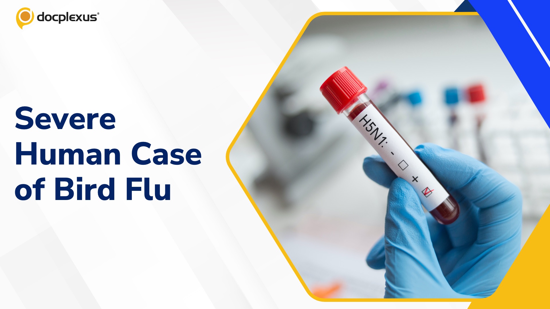 The US Reports First Severe Human Case of Bird Flu
