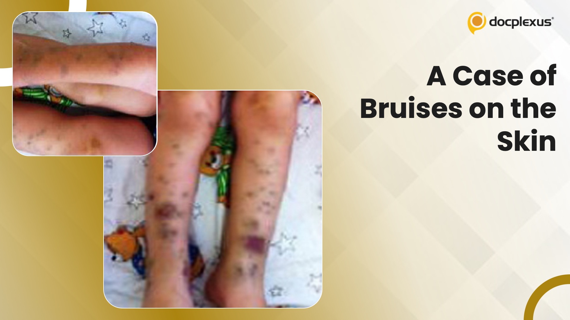 Diagnose This Case of Bruises on the Skin