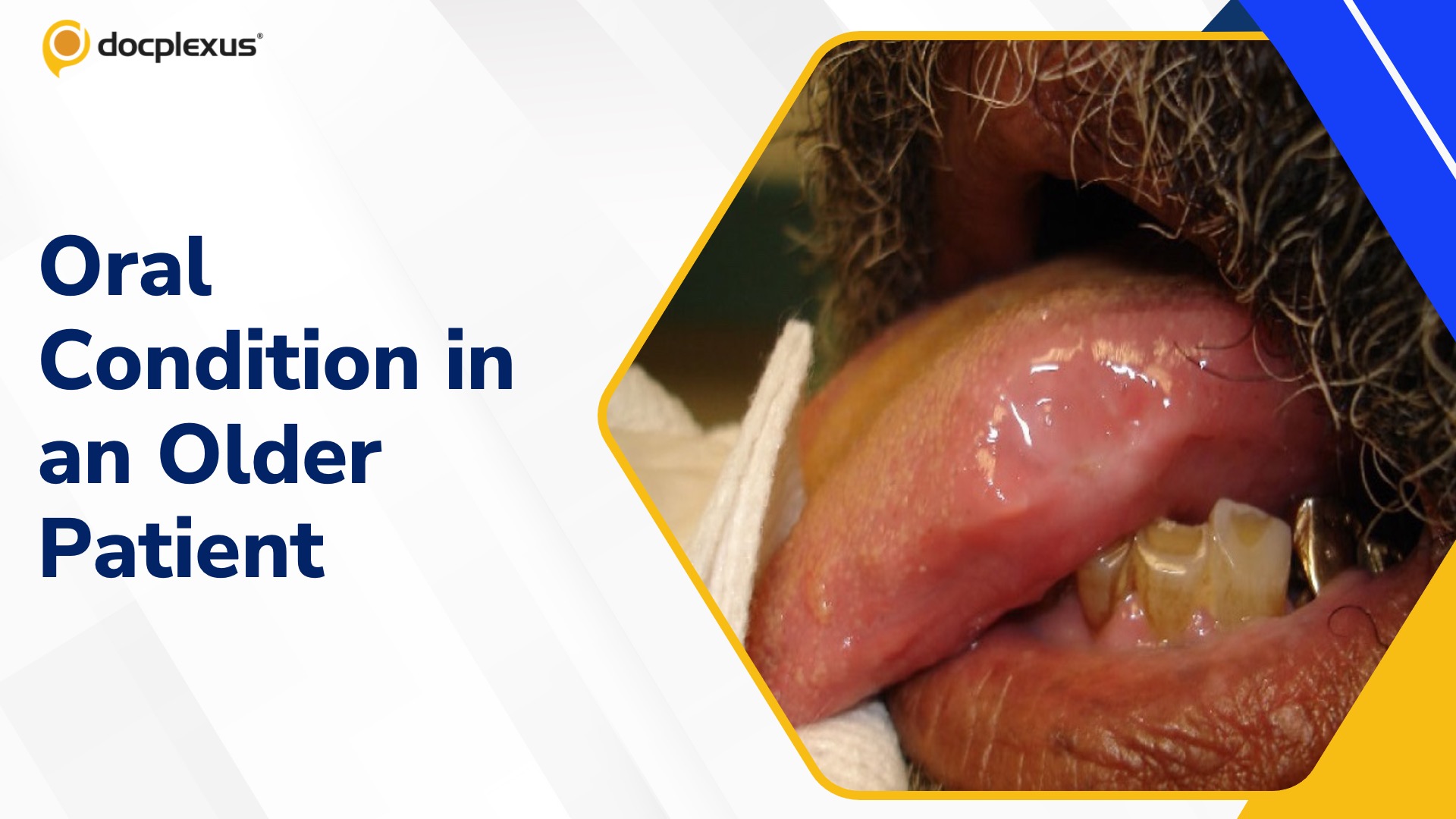Diagnose This Oral Condition in an Older Patient