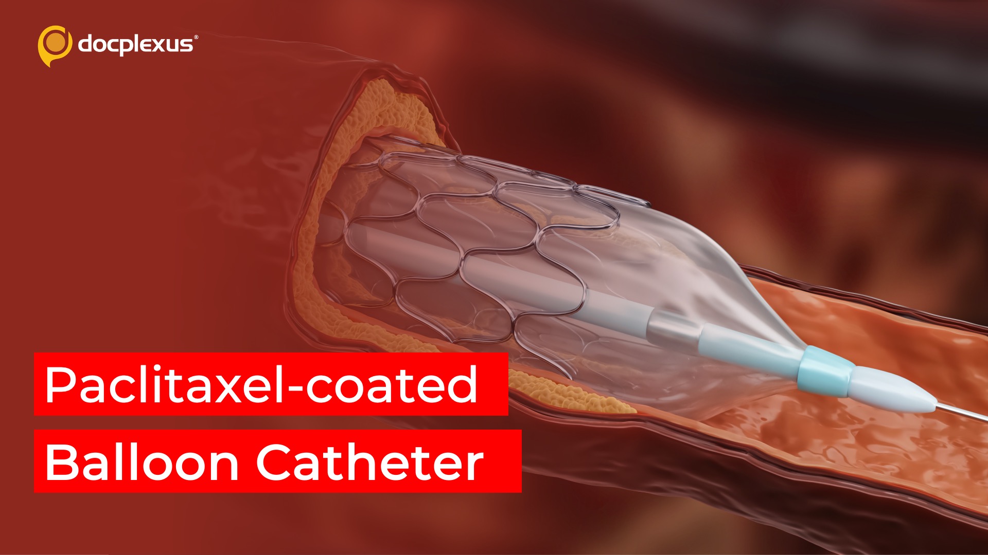 USFDA Approves Paclitaxel-coated Balloon Catheter for Coronary ISR