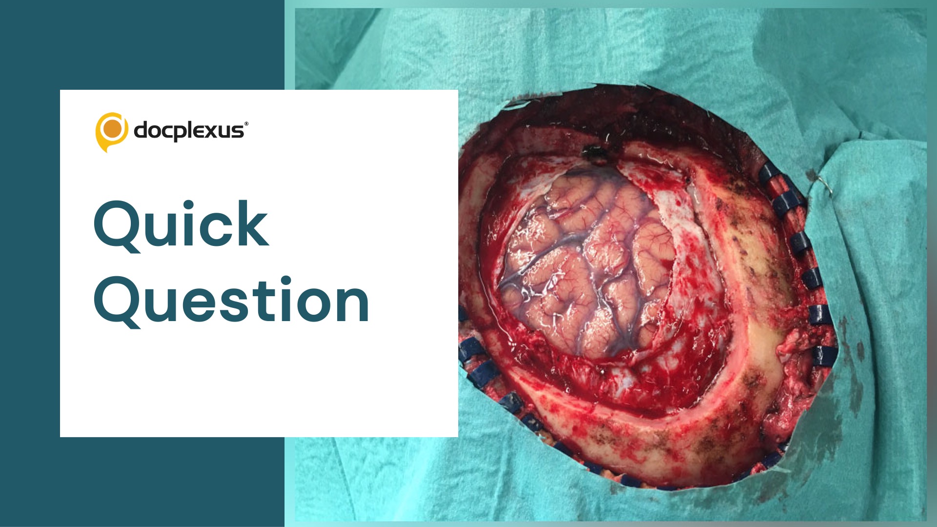 Craniotomy: Know How to Select the Right Patient