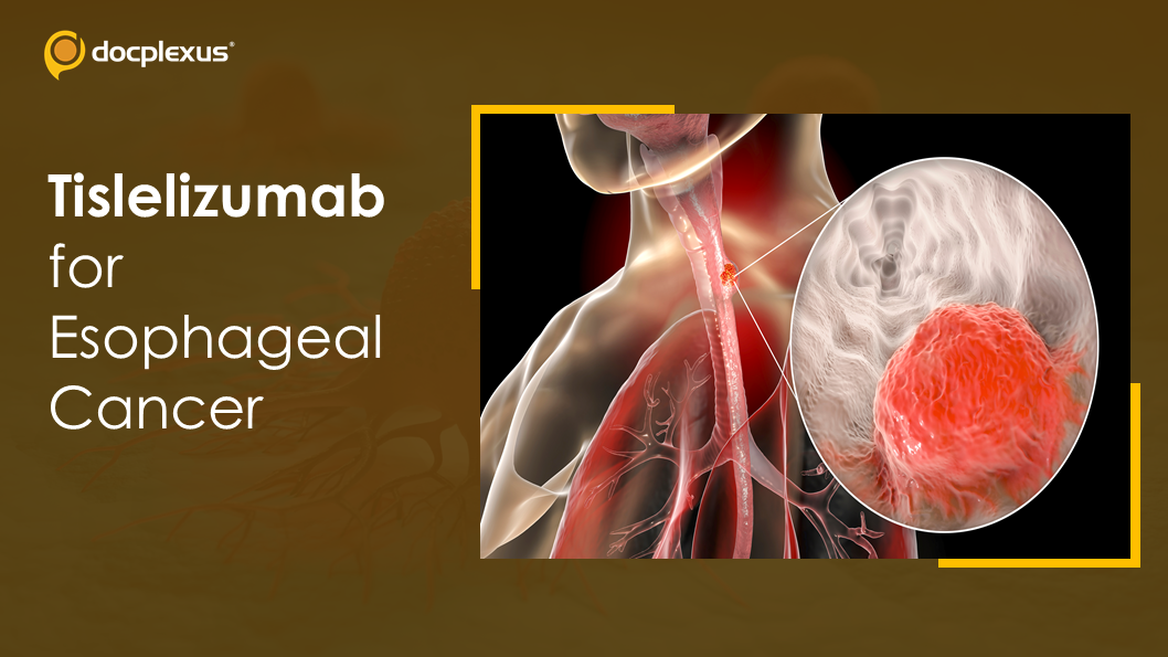 Tislelizumab for Esophageal Squamous Cell Carcinoma