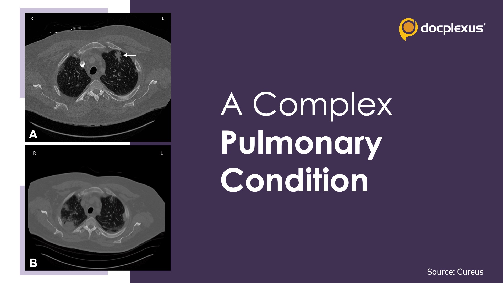 Diagnose this Rare Case of Pulmonary Manifestation