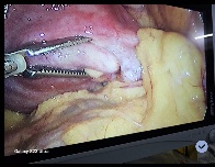 Redo Lapligation: Salvaging Ligation Failure Pregnancy