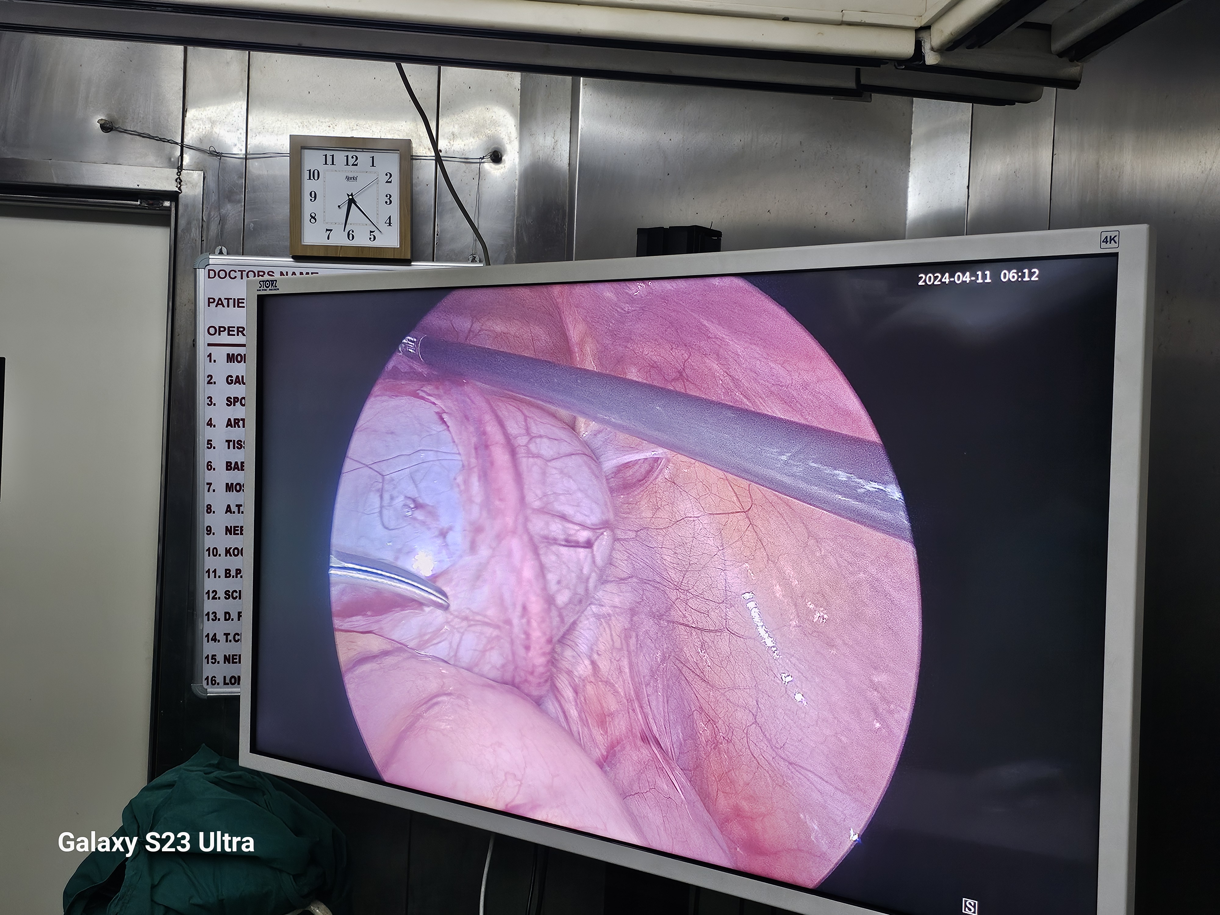 Pediatric Paraovarian Cysts