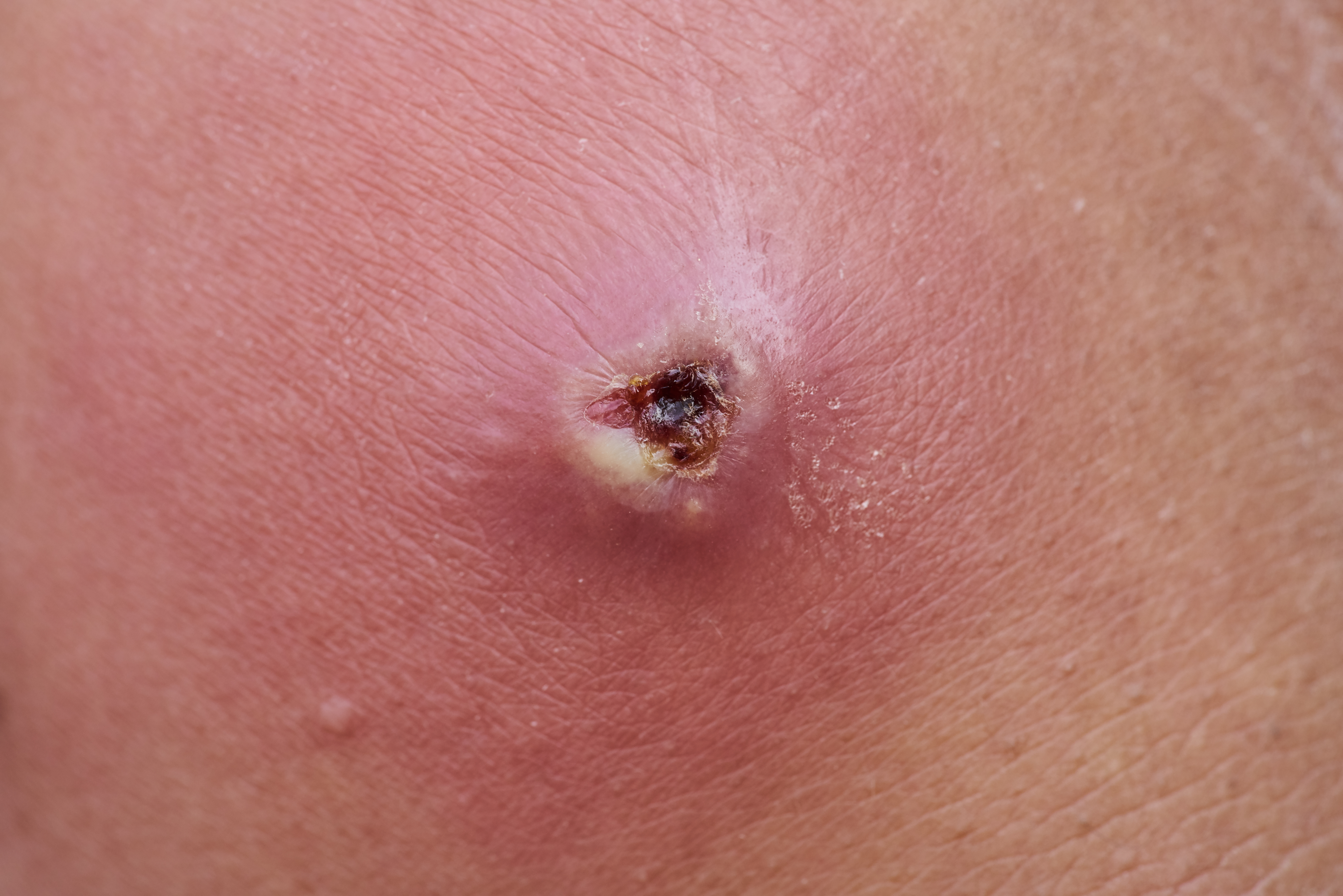 Cystic Swelling with Pus: Anterior Abdominal Wall