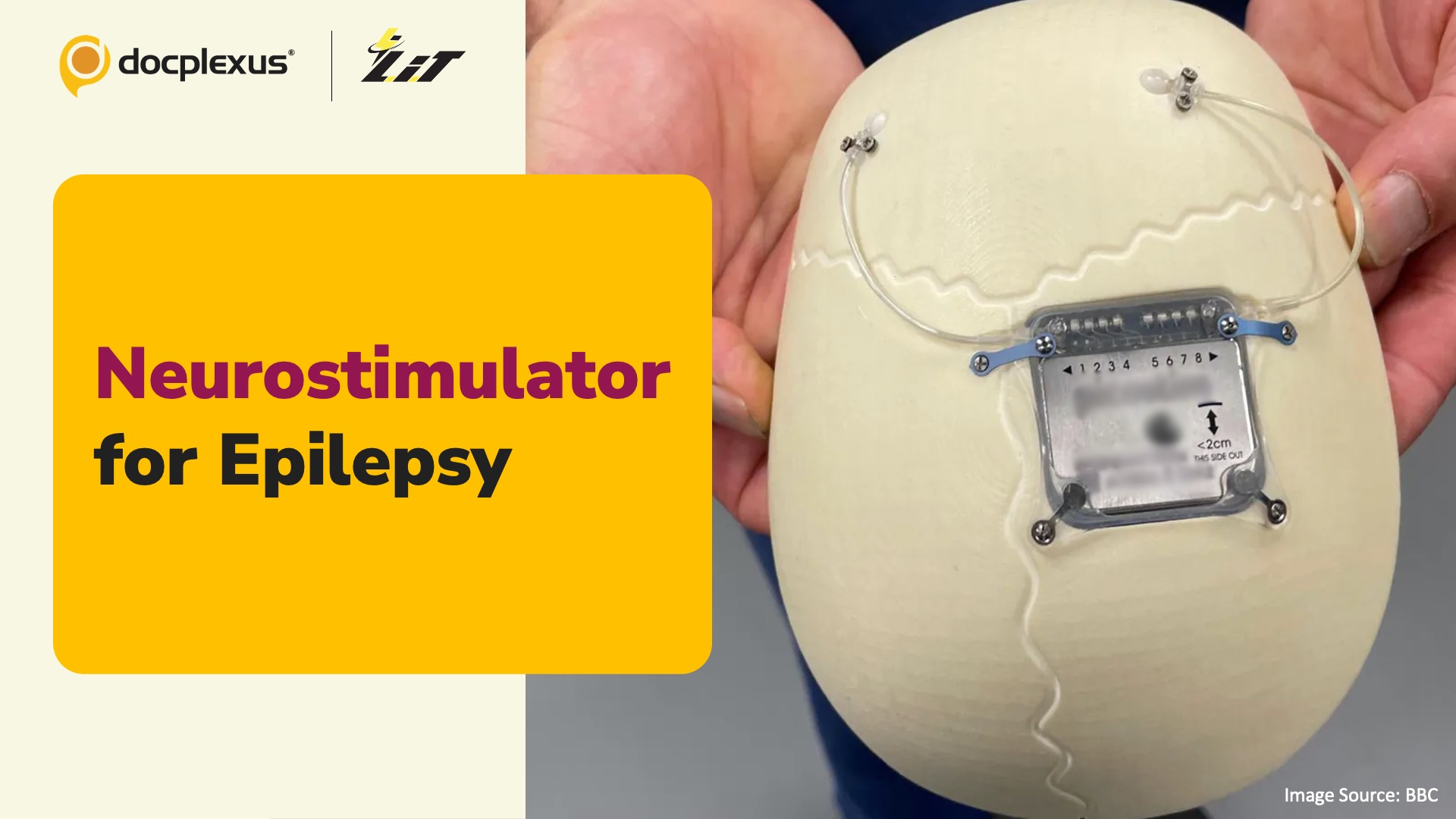 Groundbreaking Neurostimulator Trial Shows Promise for Childhood Epilepsy