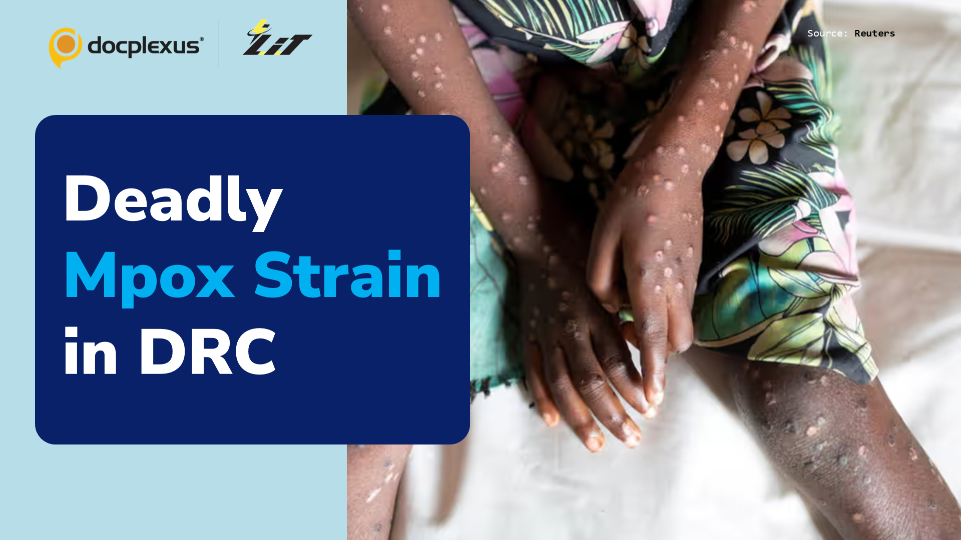 Lethal and Contagious Mpox Strain in the Democratic Republic of the Congo