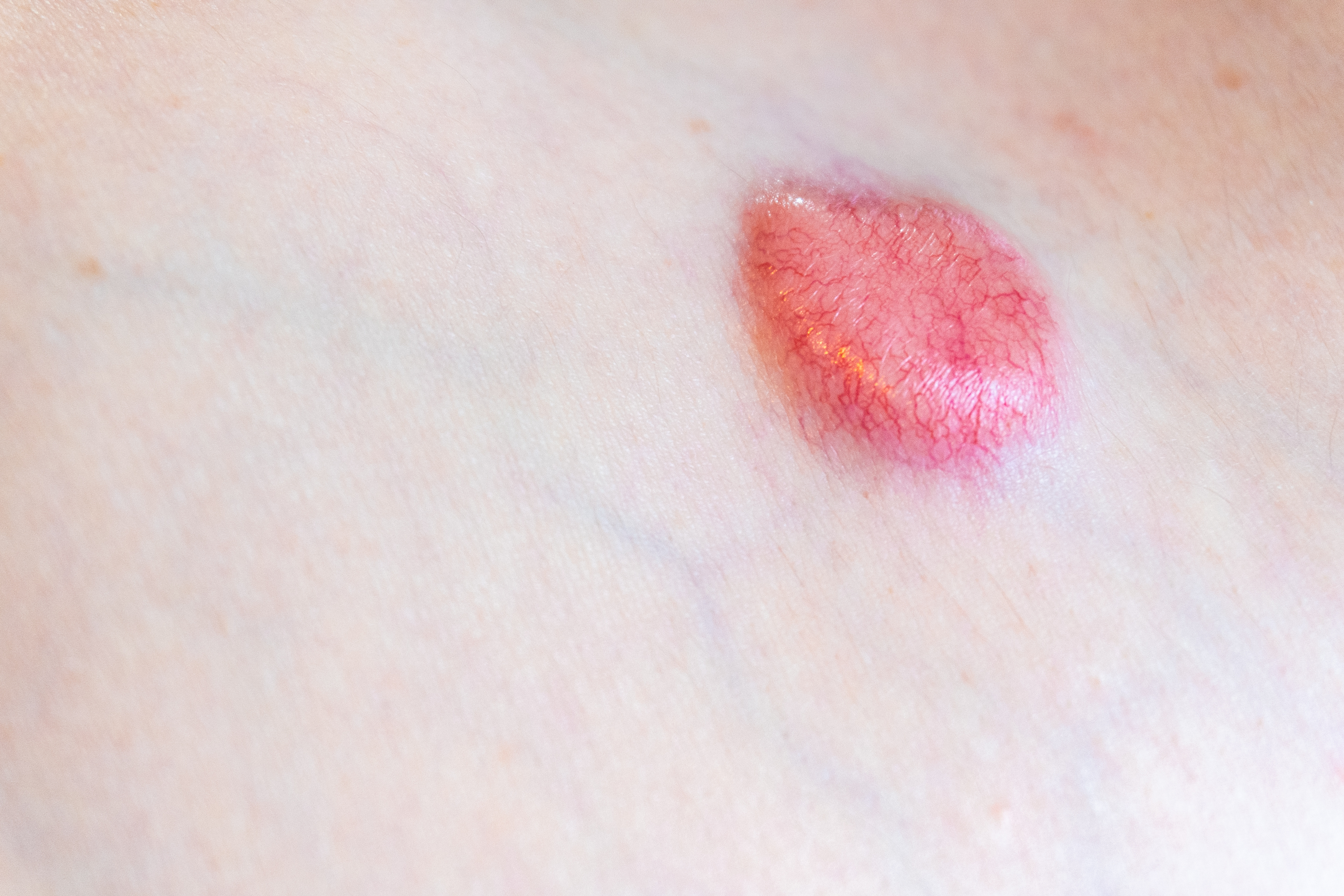 Diagnosing and Managing Dermatofibrosarcoma Protuberans of the Leg