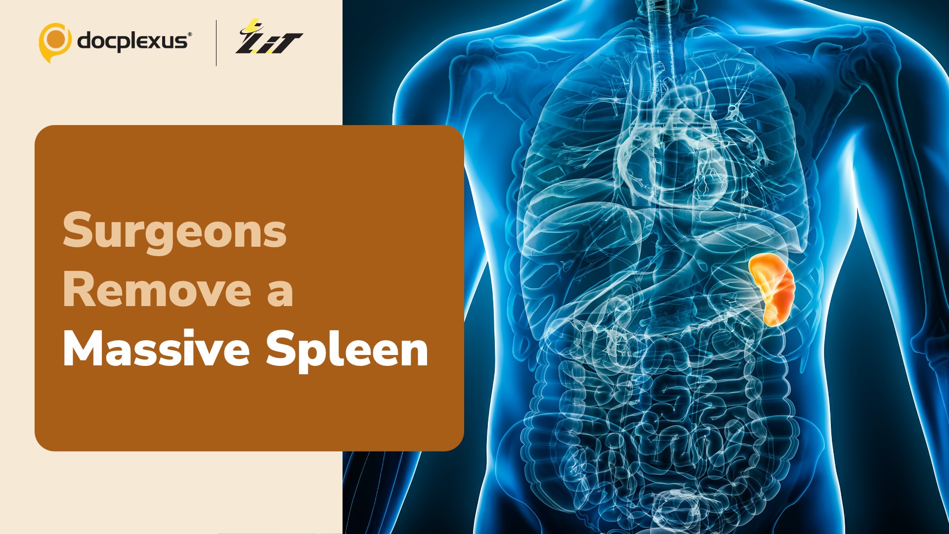 Mumbai Surgeons Remove a Massive 8.5 kg Spleen