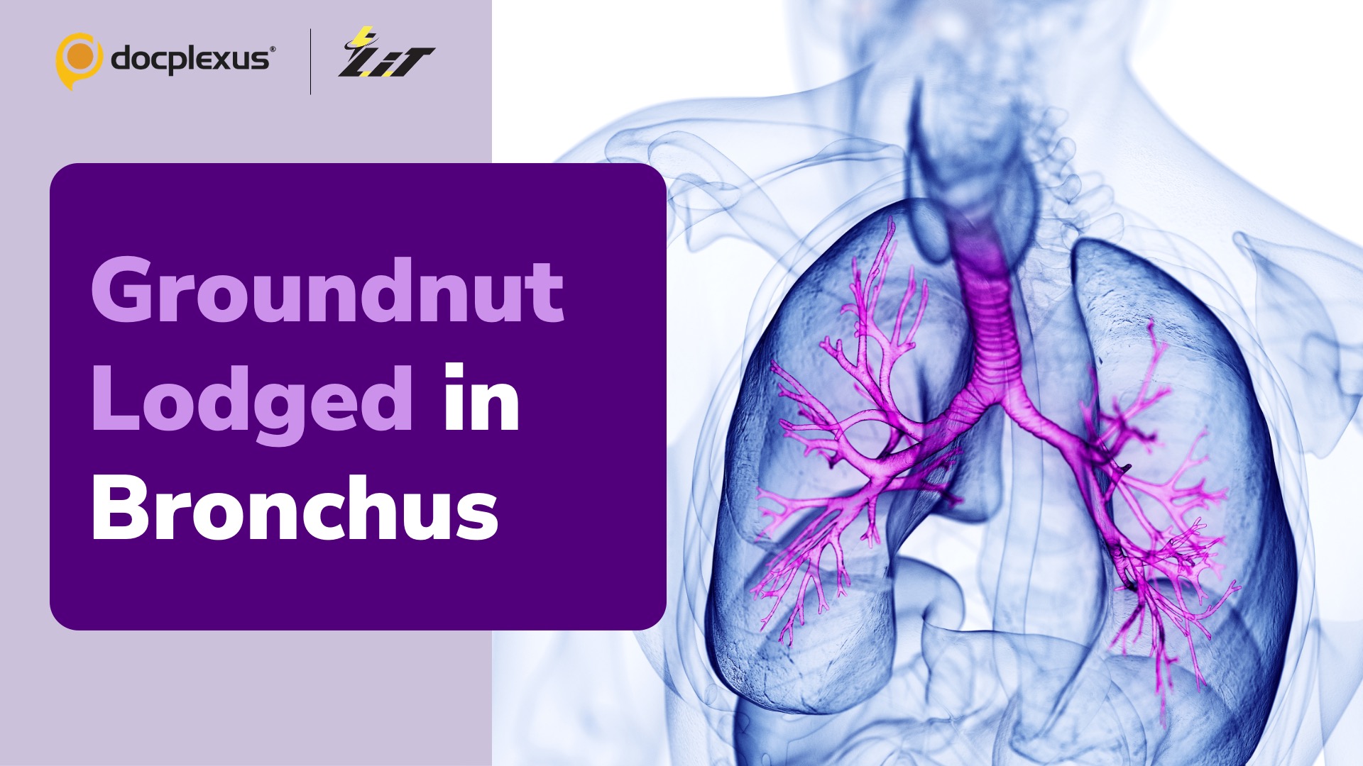 Surgeons Remove Groundnut from the Bronchus of a Child