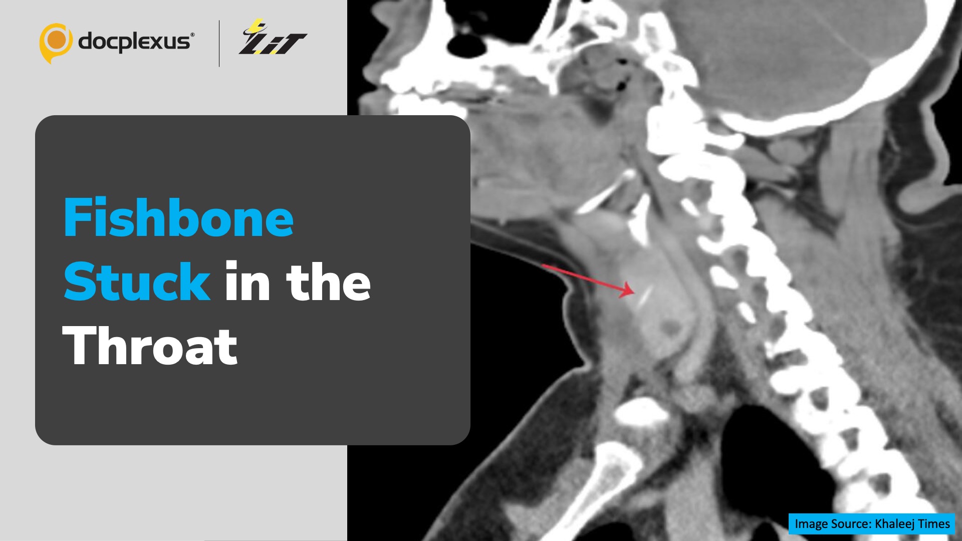 Surgeon Removes Fishbone from Patient’s Throat