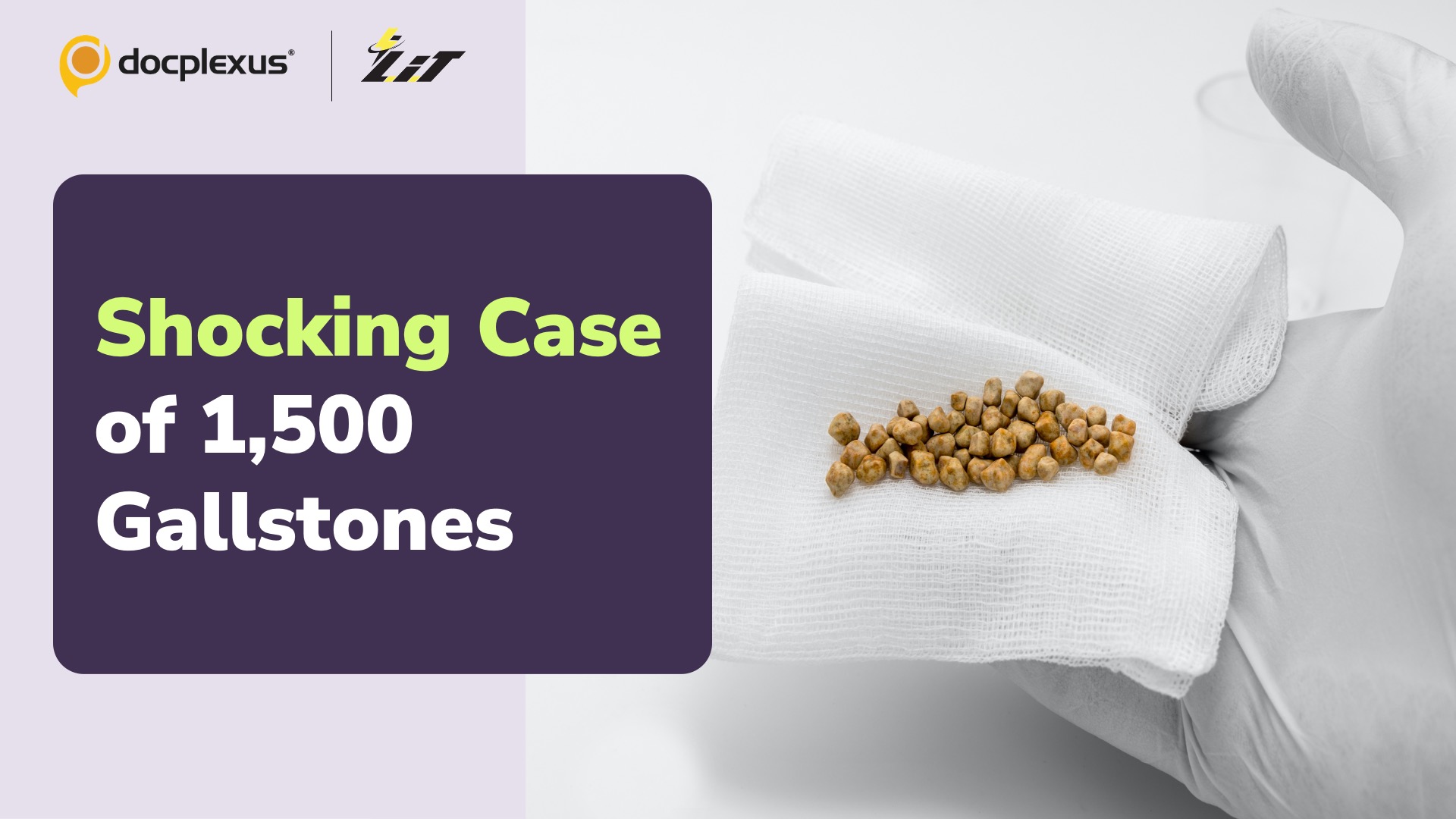 Surgeons Remove Over 1,500 Gallstones from a Patient