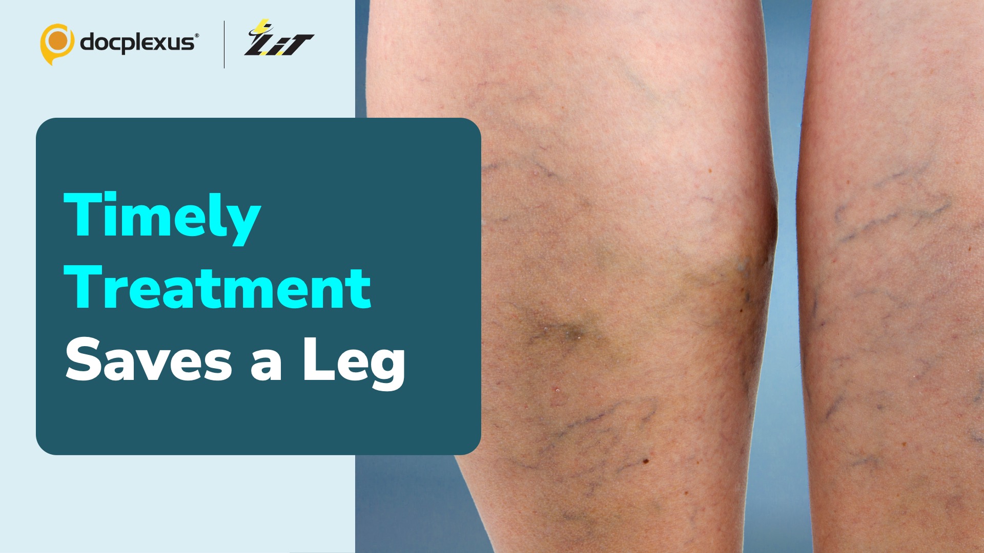 Kanpur Doctors Save Elderly Man’s Leg with a Minimally Invasive Procedure