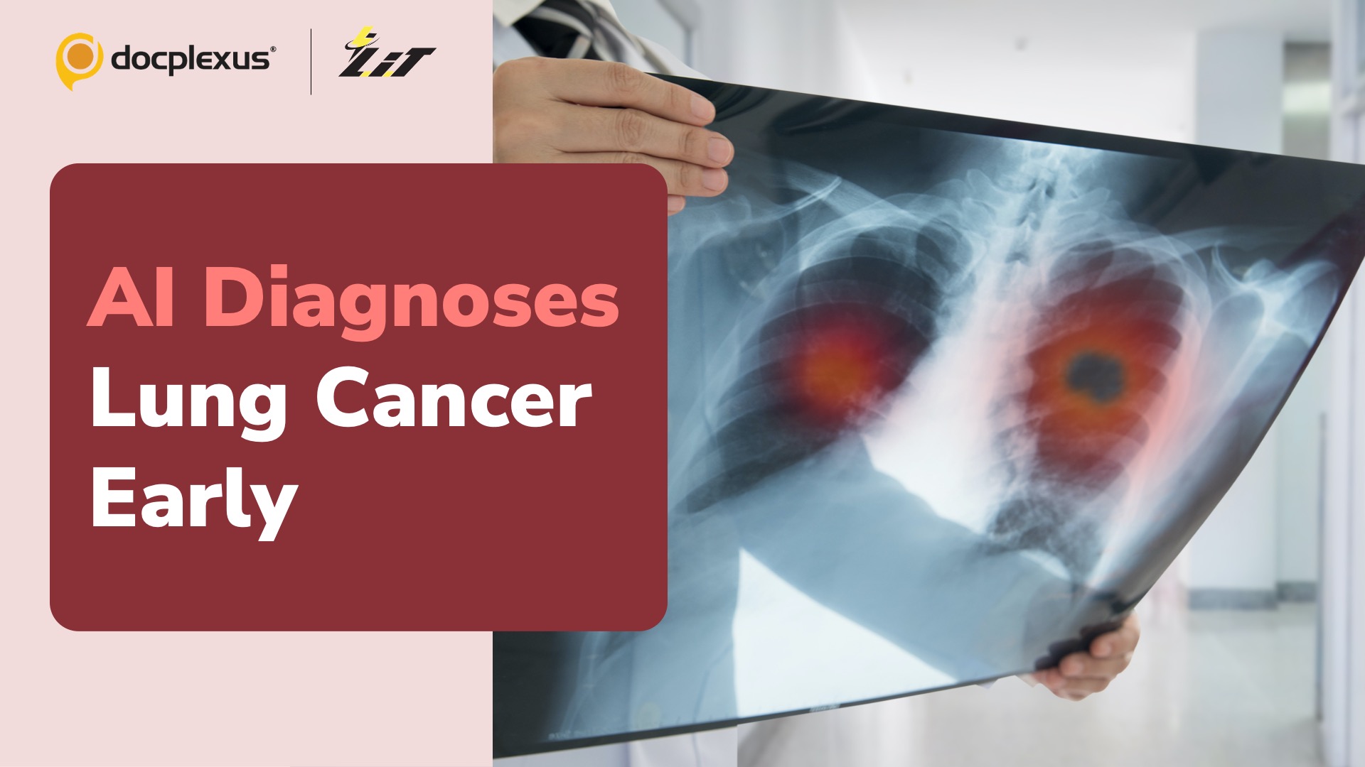 AI Helps Diagnose and Treat a Lung Cancer Case