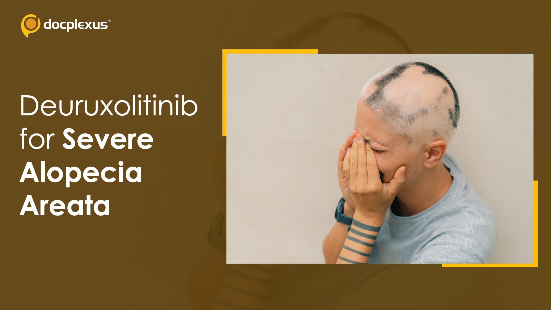 USFDA Approves Deuruxolitinib for Treating Severe Alopecia Areata