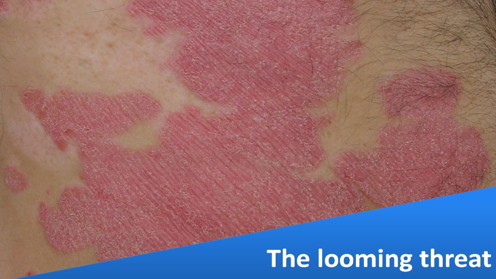 Did You Ever Ask Your Psoriasis Patients to Stop Drinking?