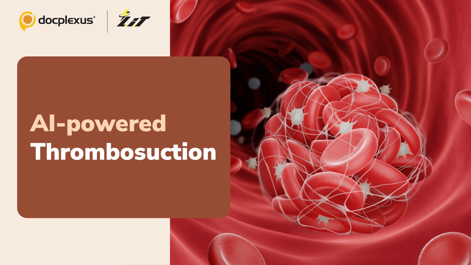 AI-powered Thrombosuction Removes Blood Clot