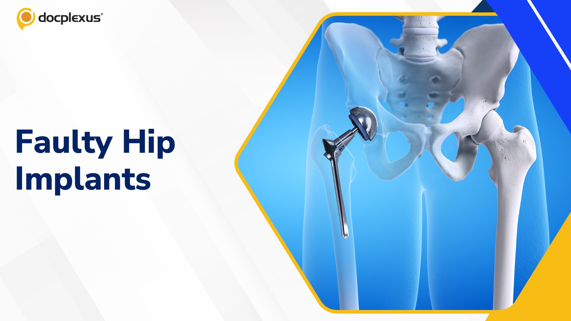 National Commission Orders Compensation for Faulty Hip Replacements