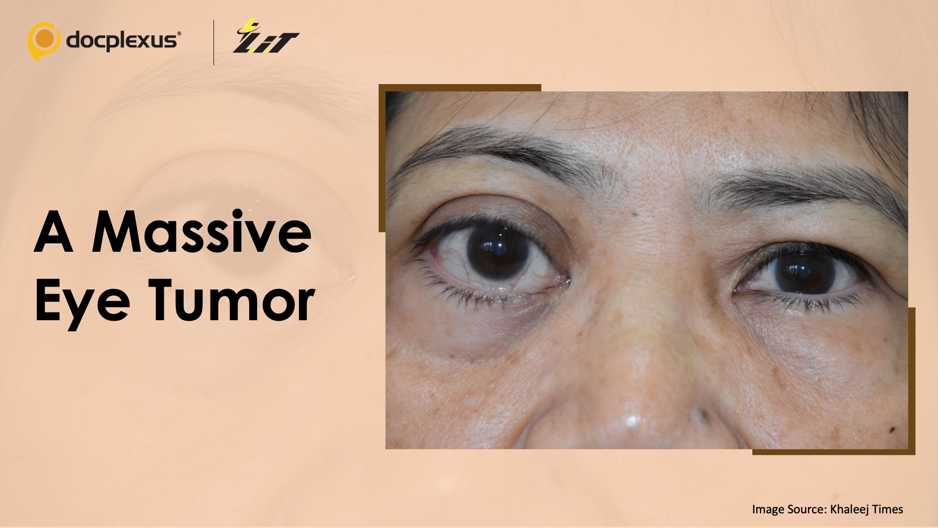 Surgeons Remove Massive Benign Eye Tumor