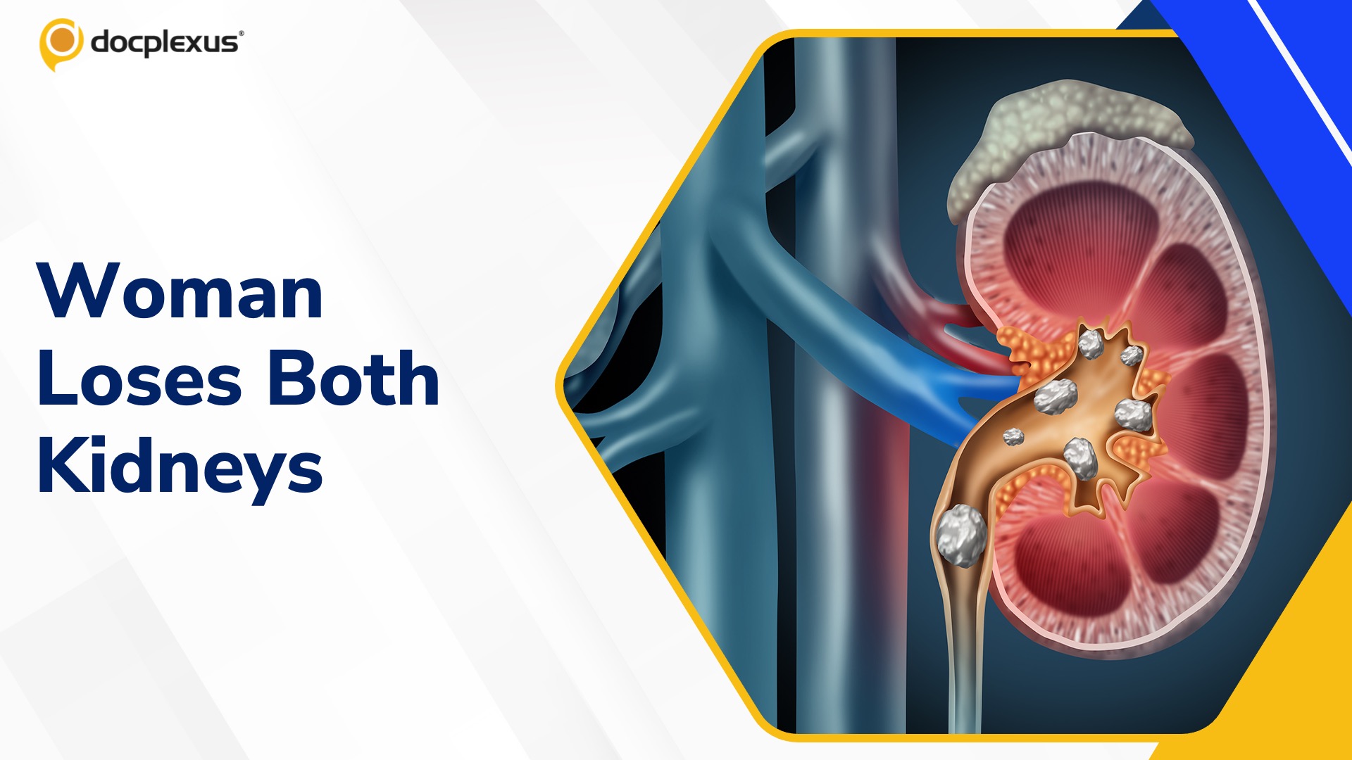 Haryana Doctor Removes Both Kidneys Instead of One