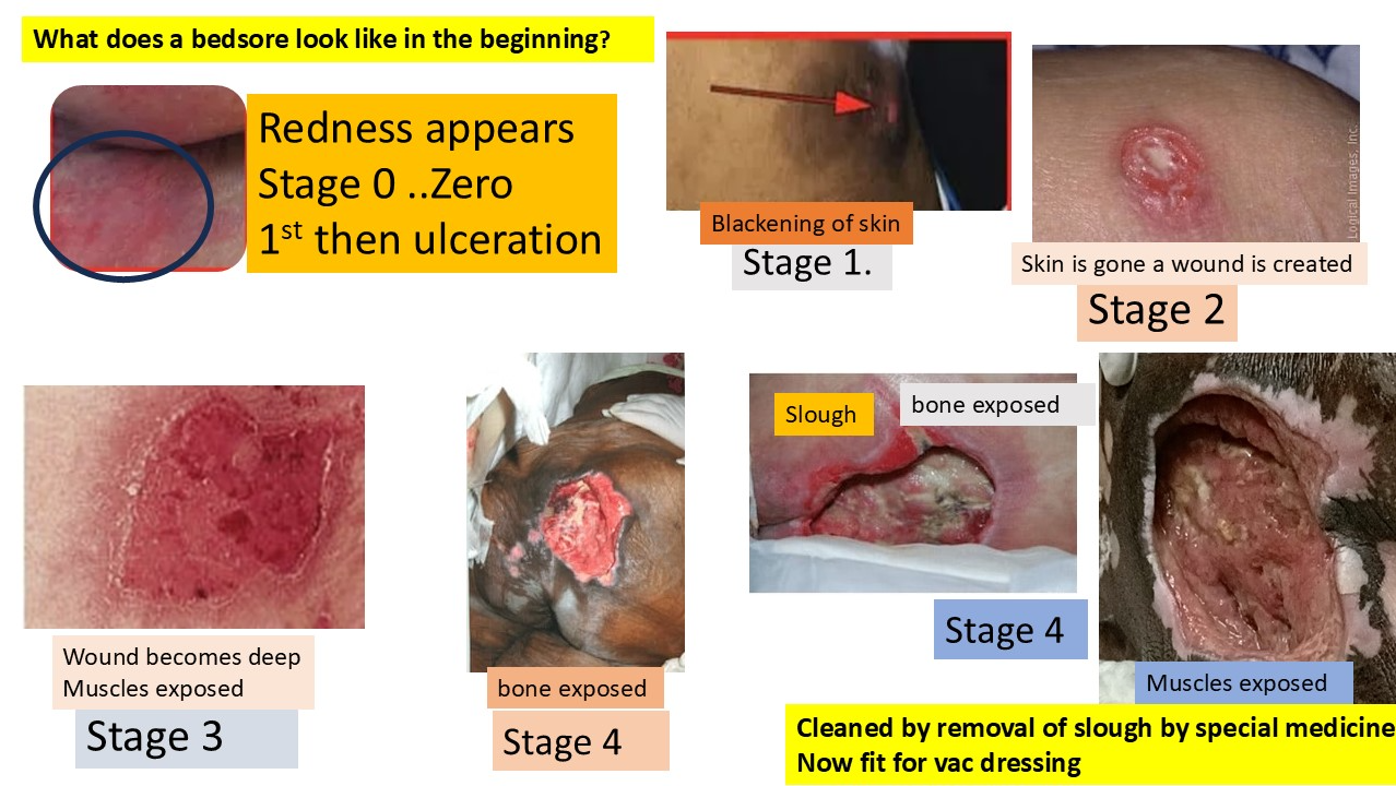 Bed Sores 